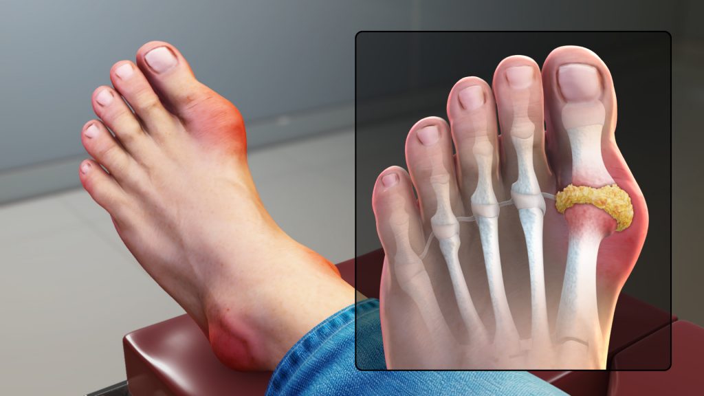 Gout Signs and Symptoms 1024x576 1
